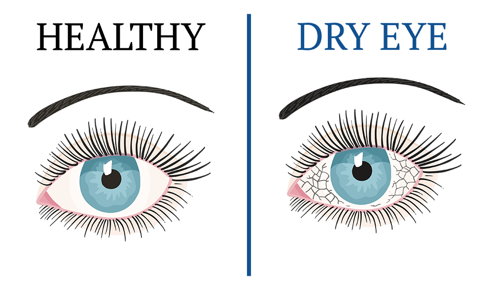 dry-eyes