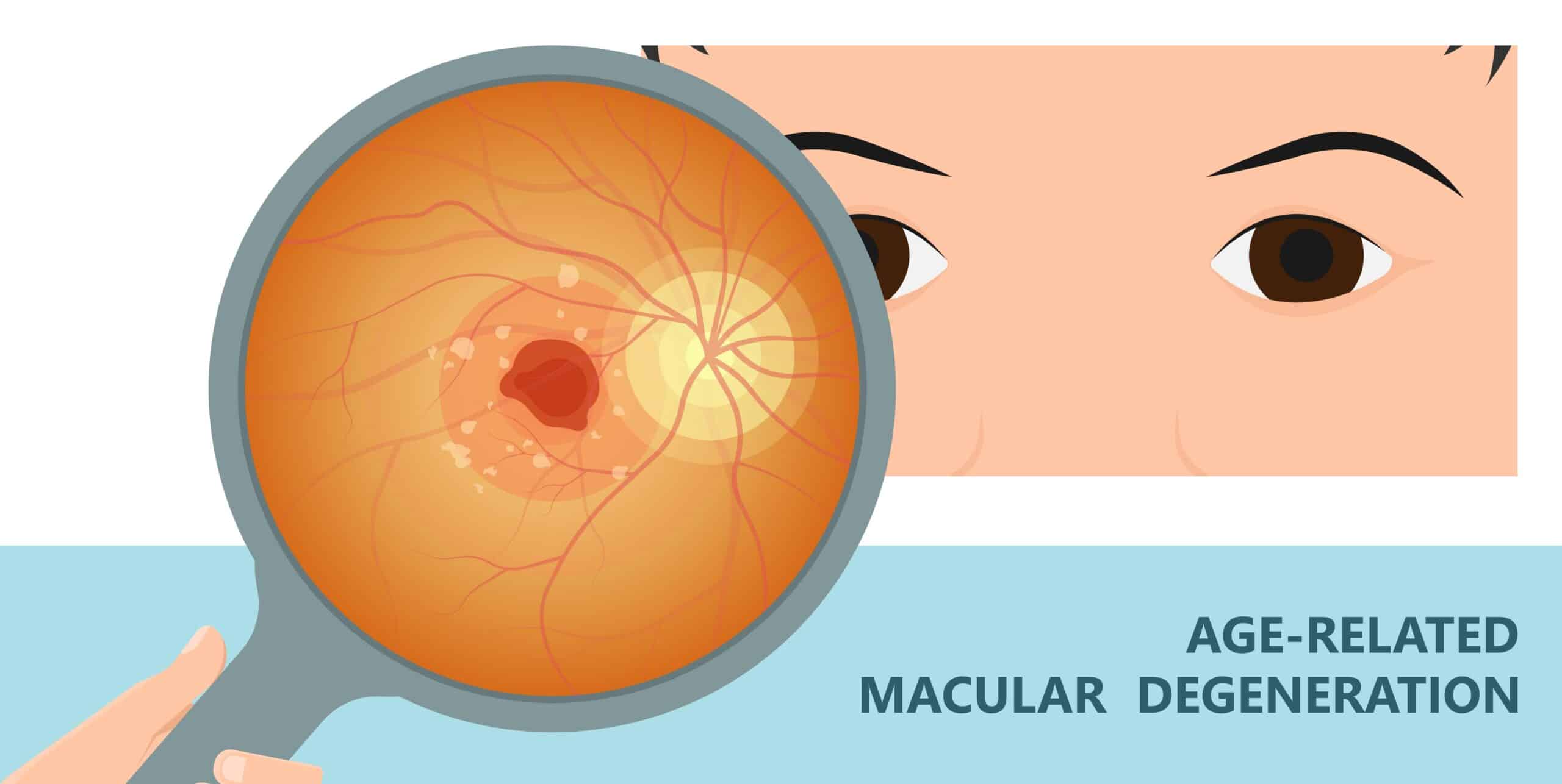 aspirin-and-age-related-macular-degeneration