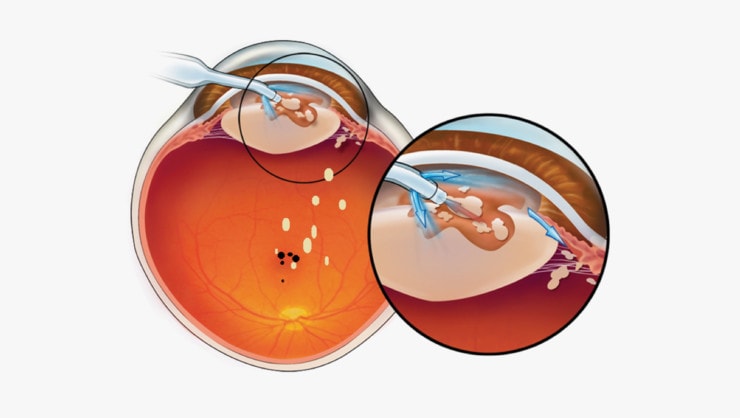surgeon-richard-cohen-m-d-announces-arrival-of-laser-cataract-surgery
