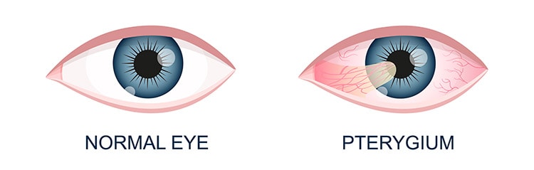 Pterygium-eye-vs-normal-eye