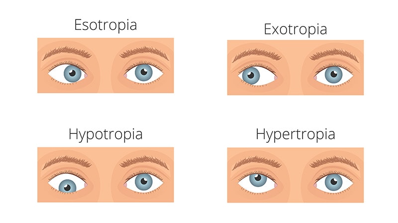 types-of-strabismus